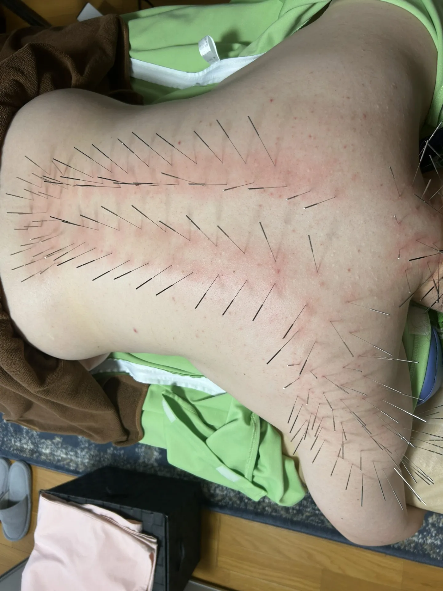 ルート鍼治療の効果と適応症の解説